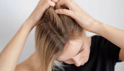 Tired of Dry Scalp in Winter? Here's How to Fix It With DIY Home Remedies