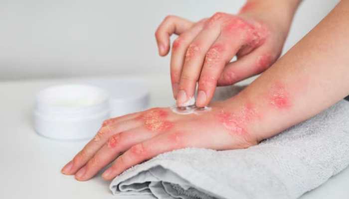 Stay Hydrated, Stay Happy: Winter Survival Guide For Eczema