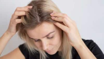 Tips To Nourish The Scalp And Fight Dryness And Flakes; Check Expert Opinion 