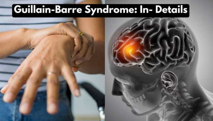 Guillain-Barre Syndrome: Doctor Shares Symptoms, And Preventions For This Rare Severe Neurological Condition  