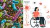 Multiple sclerosis