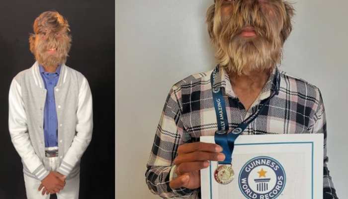 Meet The Indian Teen With The Hairiest Face – A Guinness World Record Holder!- Watch Video