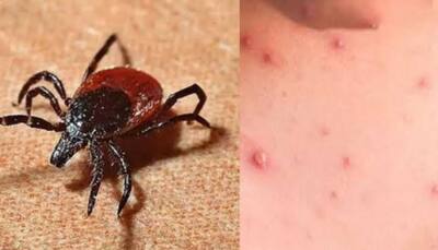 Scrub Typhus Poses High Risk To Rural Communities, Study Warns Of Rising Infections