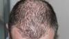 Low-Dose Antibiotics May Effectively Treat Rare Hair Loss Condition With Fewer Side Effects: Study