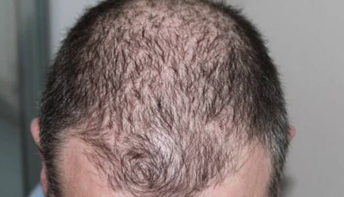 Low-Dose Antibiotics May Effectively Treat Rare Hair Loss Condition With Fewer Side Effects: Study