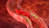 Heart disease prevention