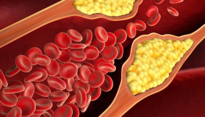 Lowering Bad Cholesterol May Reduce Dementia And Alzheimer’s Risk, Study Finds