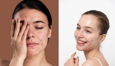 How To Use Instant Home Remedies To Tame Active Pimples And Achieve Clear Skin