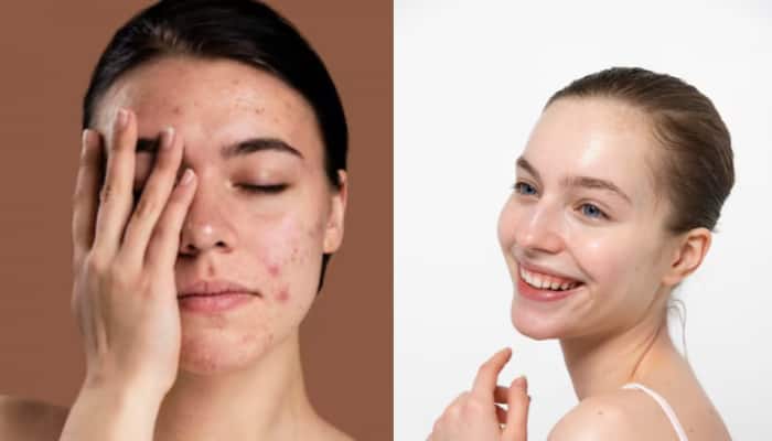 How To Use Instant Home Remedies To Tame Active Pimples And Achieve Clear Skin