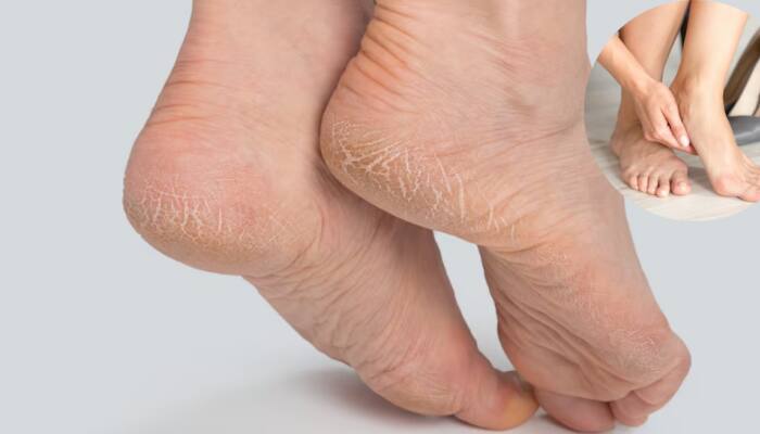 Cracked Heels Remedies: 8 Simple And Effective DIY Tips To Smooth And Soften Your Heels