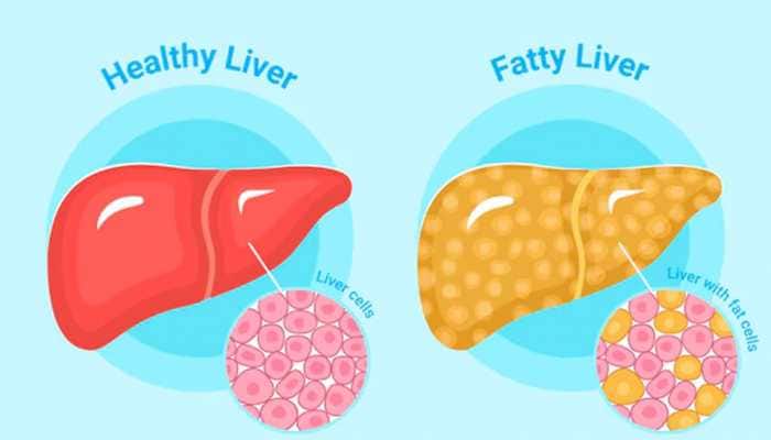 Is Sedentary Lifestyle Linked To Fatty Liver Disease? Expert Advice On MASLD