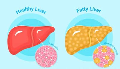 Is Sedentary Lifestyle Linked To Fatty Liver Disease? Expert Advice On MASLD