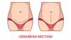 C-section