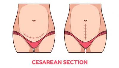 Recovering From A C-Section: What To Expect?