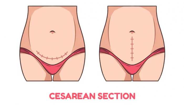 Recovering From A C-Section: What To Expect?