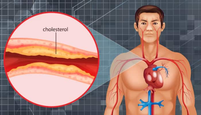 New Cholesterol-Lowering Pill Shows Promise In Cutting Heart Attack Risk