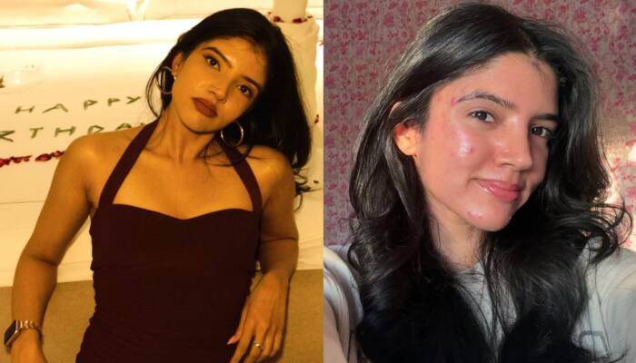 Struggling With Hormonal Breakouts? Expert Shares Skincare Routine That Helped Her Manage PCOS-Related Acne