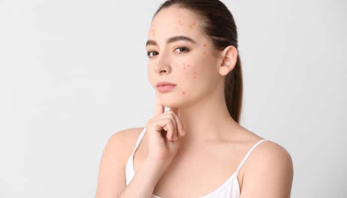 Clear Start: The Ultimate Morning Skincare Routine for Acne-Prone Skin