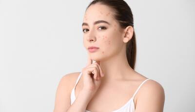 Clear Start: The Ultimate Morning Skincare Routine for Acne-Prone Skin