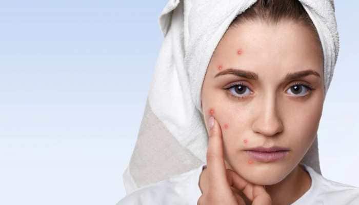 Beating Acne in the Indian Climate: Evening Skincare Routine