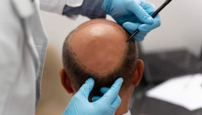 Botched Hair Transplant Surgery Kills Two Men In Kanpur: What Went Wrong?