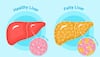 Liver cancer
