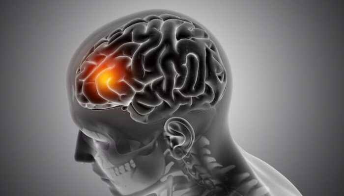 World Brain Tumour Day 2025: Early Diagnosis And Awareness Key To Brain Health For All Ages