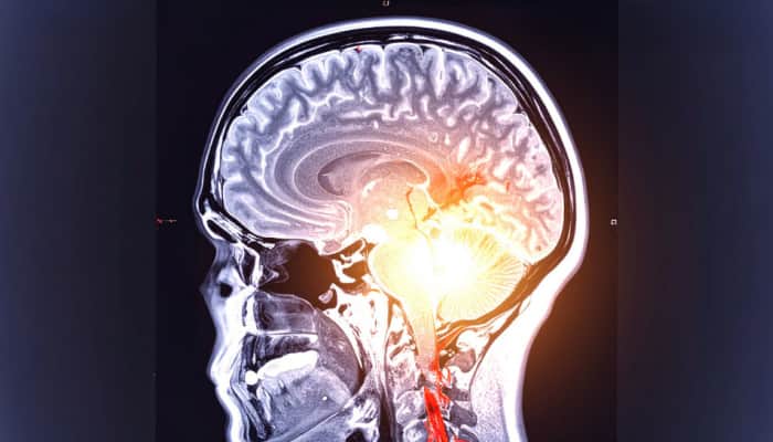 Oral And Gut Bacteria Linked To Worsening Dementia In Parkinson's: New Study 