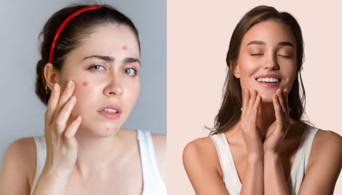Breakouts To Glow: A 3-Month Skincare Plan That Transform Your Skin Naturally
