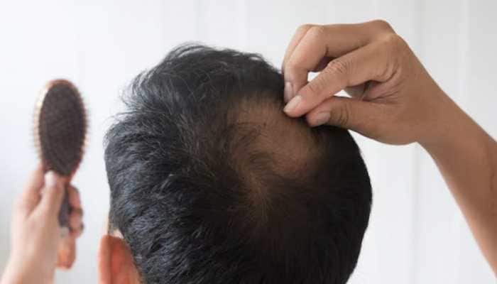 How Stress Accelerates Hair Loss In Men?