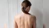 How To Treat Back Acne: 8 Simple And Effective Skincare Hacks You Can Try At Home