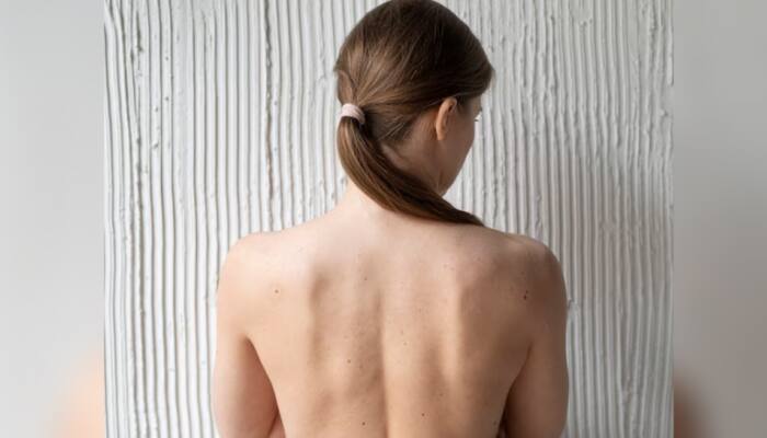 How To Treat Back Acne: 8 Simple And Effective Skincare Hacks You Can Try At Home