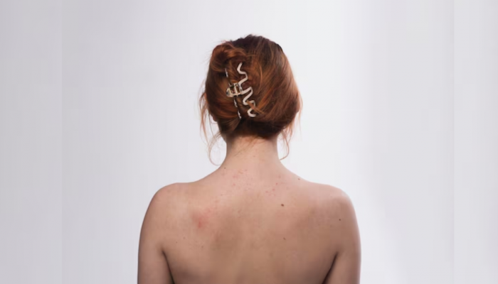 Struggling With Back Acne? Try These 10 Natural Home Remedies That Actually Work Struggling With Back Acne? Try These 10 Natural Home Remedies That Actually Work