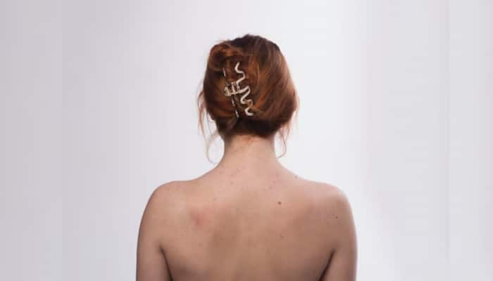 Struggling With Back Acne? Try These 10 Natural Home Remedies That Actually Work