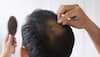 Hair loss