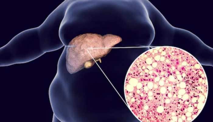 The Role Of Diet And Early Detection In Reversing Fatty Liver Disease