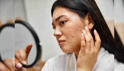Say Goodbye To Pimples In 24 Hours: 8 Safe And Fast-Acting Methods That Help