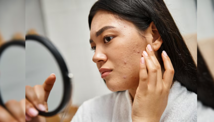 Say Goodbye To Pimples In 24 Hours: 8 Safe And Fast-Acting Methods That Help Say Goodbye To Pimples In 24 Hours: 8 Safe And Fast-Acting Methods That Help