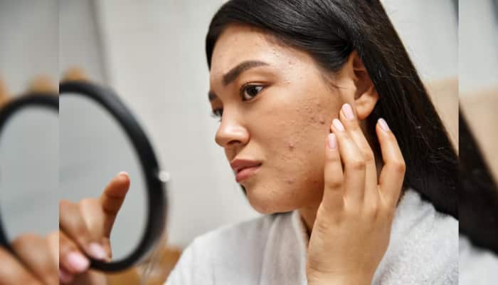 Say Goodbye To Pimples In 24 Hours: 8 Safe And Fast-Acting Methods That Help