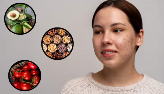 7 Nutrient-Rich Foods That Naturally Help Control Sebum Levels And Prevent Acne
