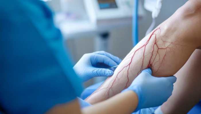 Monsoon Can Worsen Vascular Conditions, Prompt Care Is Essential, Warns Expert