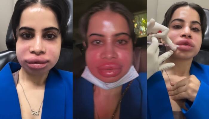 VIRAL VIDEO: Uorfi Javed REMOVED Lip Filler After 9 Years, Reveals SHOCKING Reason – WATCH
