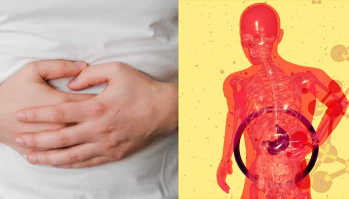 Do Spicy Foods Really Cause Ulcers? Doctor Clears Up Common Myths About Ulcers