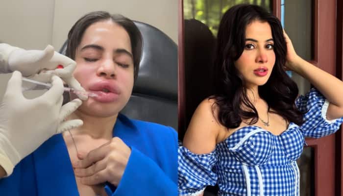 Uorfi Javed Dissolves Her Lip Fillers: Expert Reveals Shocking Truths! All You Need To Know