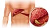 liver cirrhosis treatment