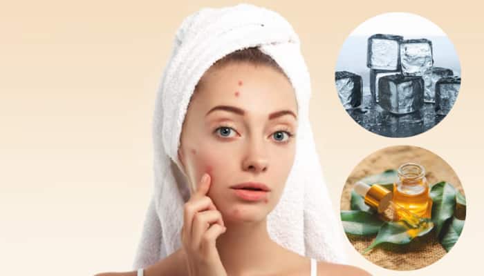 How To Get Rid Of Pimples Naturally: Tea Tree Oil, Honey Masks, And Home Hacks That Really Work For Acne-Prone Skin