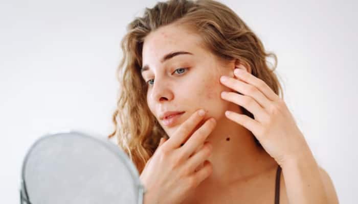From Blemishes To Beautiful Skin: How To Pop Pimples Safely Without Causing Scars Or Marks