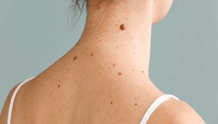 Troubled By Moles On Your Skin? Try These Easy Home Remedies For Naturally Glowing Skin