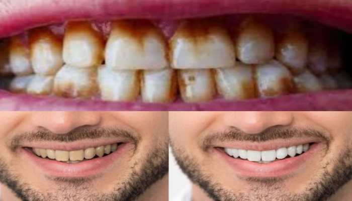Yellow Teeth From Tobacco And Gutkha? Try These 4 Simple Home Remedies To Shine Your Smile