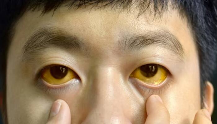 5 Major Causes Of Jaundice In Adults And Children You Should Never Ignore For Early Detection And Treatment